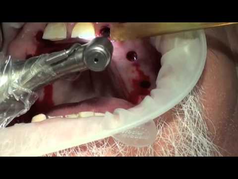 cirugía dental - Colocación de 6 implantes oseointegrados en máxilar superior con cirugía mínimamente invasiva.