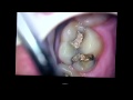 fractured tooth #14 saved from vertical crack