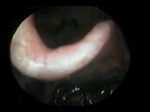larynx trauma