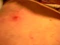 Popping a huge Zit Popping a huge Zit
