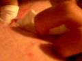 Popping a huge Zit