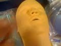 What is a Fenestrated Tracheostomy?