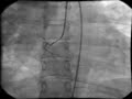 intracardiac-cathete