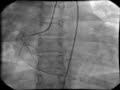 intracardiac-cathete