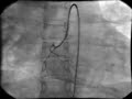 intracardiac-cathete