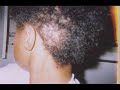 Natural treatment and products for eczema and thinning Hair