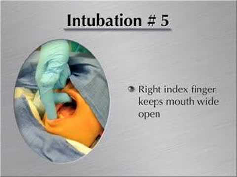 how to intubate
