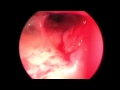 Balloon Dilation of Ostium under Local Anesthesia Balloon Dilation of Ostium under Local Anesthesia