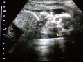 Our son at 20 weeks