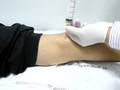 Aspration Of Baker Cyst In A Popliteal Fossa Aspration Of Baker Cyst In A Popliteal Fossa