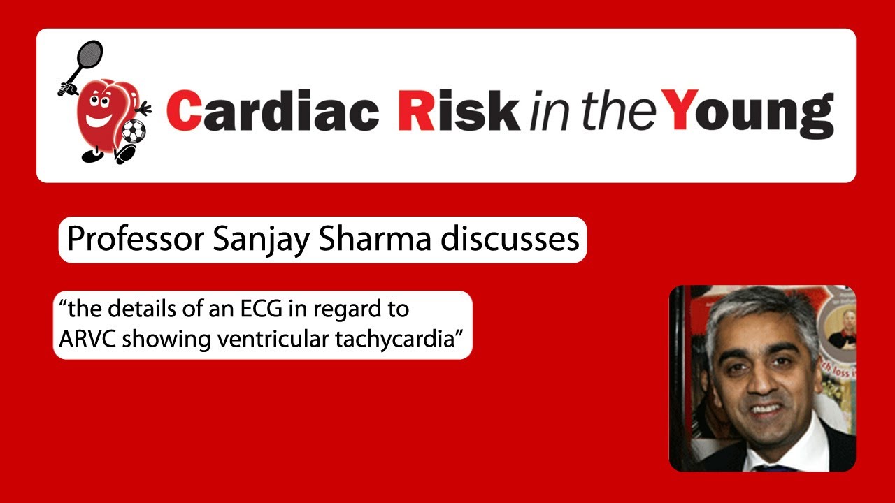 ECG 8: ARVC showing ventricular tachycardia