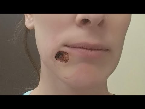 Progressvideo Tv 39 Blackhead 39 On Woman 39 S Chin Turned