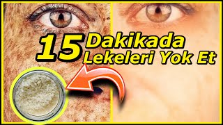 15 Dakikada CİLT LEKELERİ  Sivilce ve AKNE İzle