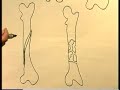 Fractures