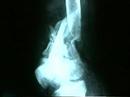 Fractures