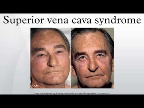 how to treat svc syndrome
