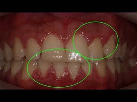 how to relieve gum swelling
