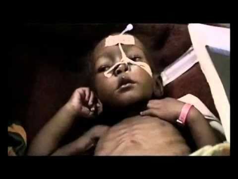 how to cure kwashiorkor