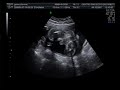 Agustin - Ecografia 4D 28 Semanas Agustin - Ecografia 4D 28 Semanas