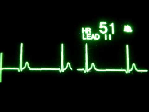 how to treat junctional tachycardia