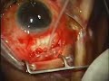 Ahmed Valve Surgery for Glaucoma PART2