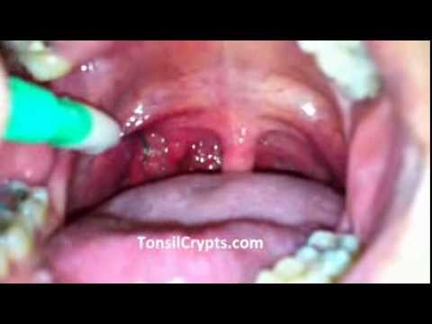 how to locate tonsils