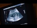 13 weeks 1 day ultrasound