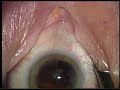 Posterior Capsule Rupture Posterior Capsule Rupture