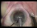 Posterior Capsule Rupture