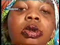 milagros del espiritu santo en sanidad de cancer en labios
