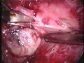 Endometriosis Severa (1º Parte) Endometriosis Severa (1º Parte)