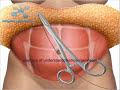 Tummy Tuck Muscle Repair with 3D CAT scan