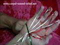 Carpal Tunnel Syndrome Explained Carpal Tunnel Syndrome Explained