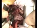 Sostituzione valvola aortica con tecnica mini-invasiva