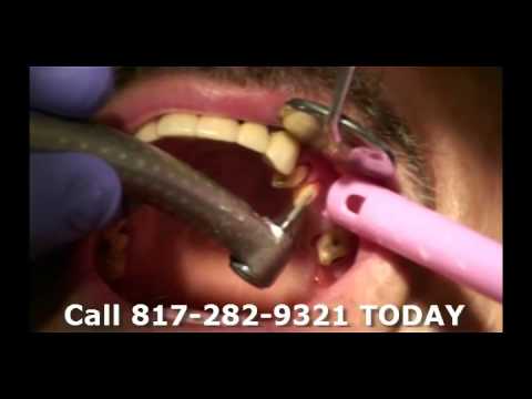 how to whiten permanent bridges
