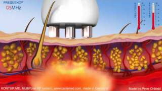 KONTUR MD - MULTIPOLAR RF DEVICE WITH DVTP (from CARISMED GmbH Germany)