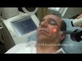 Acne Scar Removal and Skin Tightening Middle Eastern Patient Acne Scar Removal and Skin Tightening Middle Eastern Patient