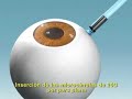 Biopsia transv�trea de melanoma de coroides - Dr. J.Elizalde