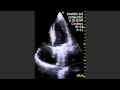Infective Endocardium Inflammation Due To Artificial Biscupidal Valve Infective Endocardium Inflammation Due To Artificial Biscupidal Valve