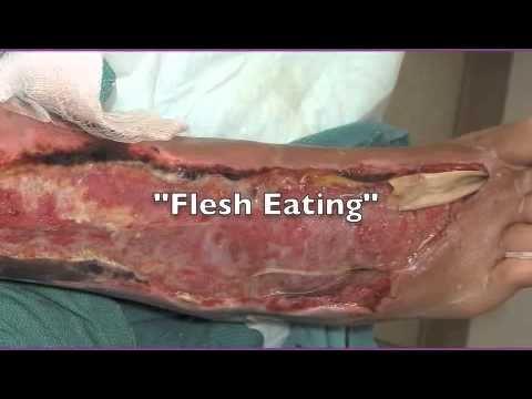 how to control group b strep