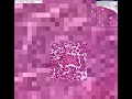 Histopathology Lung --Bronchopneumonia with micro-abscesses Abscesses