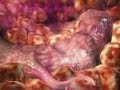 Inhibici�nVEGF y angiog�nesis contr c�ncer