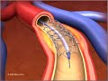 What is ANGIOPLASTY and STENTING? What is ANGIOPLASTY and STENTING?
