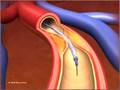 What is ANGIOPLASTY and STENTING?