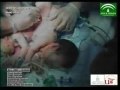 Ciencia / Salud:Separan a dos siamesas unidas por el abdomen