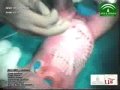 Ciencia / Salud:Separan a dos siamesas unidas por el abdomen
