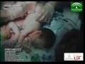 Ciencia / Salud:Separan a dos siamesas unidas por el abdomen