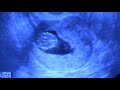 Baby echo 11 weken