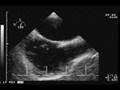 videos de TEE Chiari network