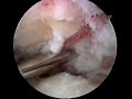 Arthroscopic Subacromial Decompression